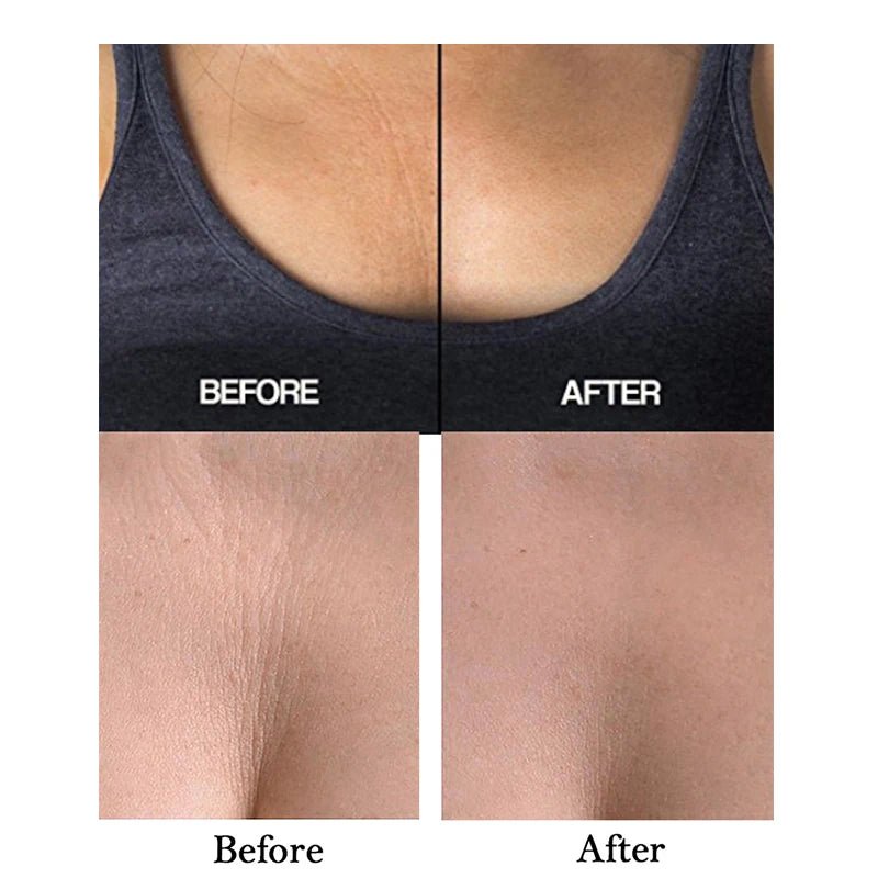 silicone chest wrinkle patch